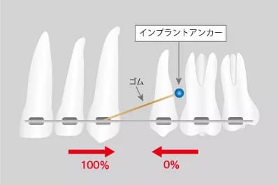 インプラントアンカー