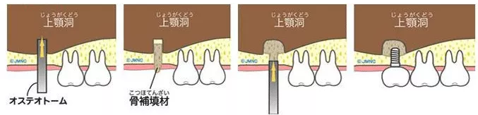 ソケットリフト