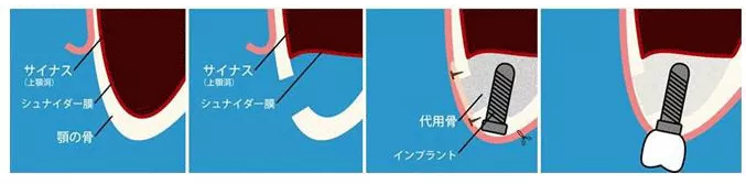 サイナスリフト