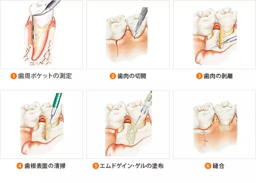 エムドゲイン工程