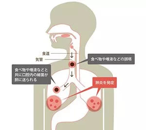 精密診断で誤嚥性肺炎のリスクを軽減