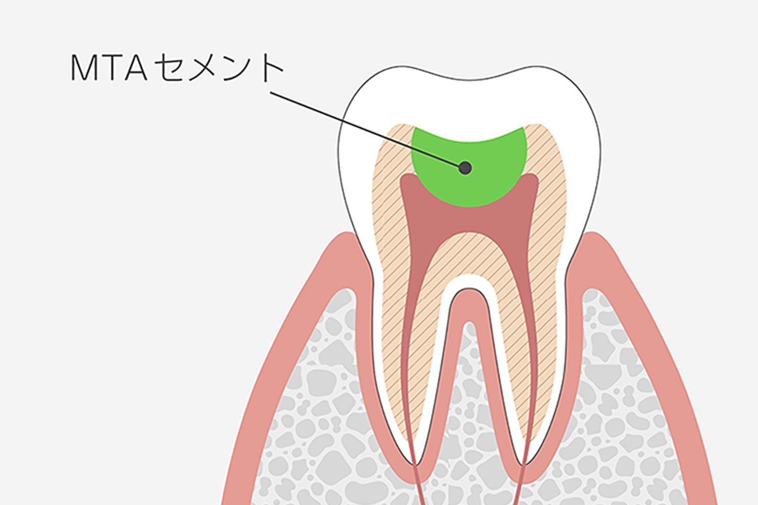MTAセメントを用いた神経温存処置